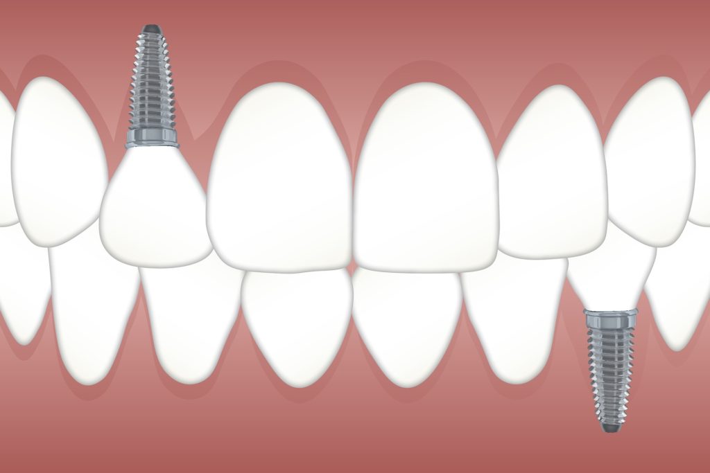 Dental Implant Recovery